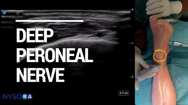 Regional Anesthesia Ultrasound-Guided Ankle Block смотреть онлайн