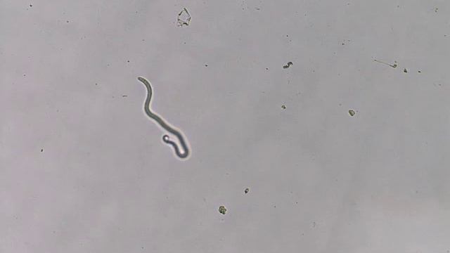 Onchocerca volvulus i skin snip смотреть онлайн