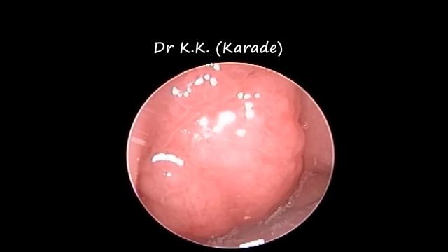 Adenoid : How It Looks Like ?