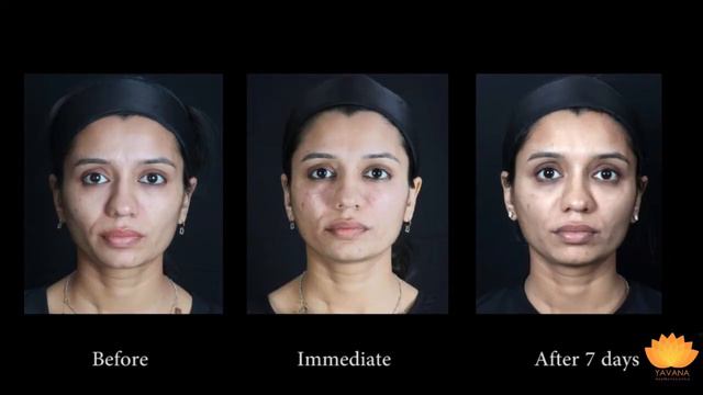 MD codes for MidFace Lift with Voluma Filler смотреть онлайн
