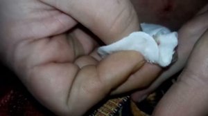 Выдавливание жировика