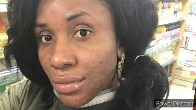 TCA peel beginner's guide/applying 15% TCA peel at home смотреть онлайн