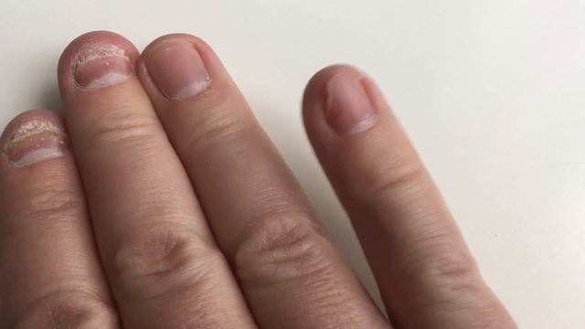 Terbinafine - Treating My Fingernail Fungus (Lamisil Generic Pills) Part. 1 смотреть онлайн