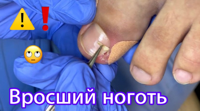 Вросший ноготь?⚠️❗️?? смотреть онлайн