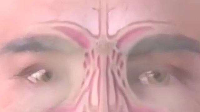 Что такое синусит?