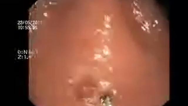 Колоноскопия ДИАНТЕК: Обработка полипа радиоволной. смотреть онлайн