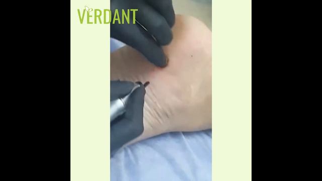 Лазерное удаление смотреть онлайн