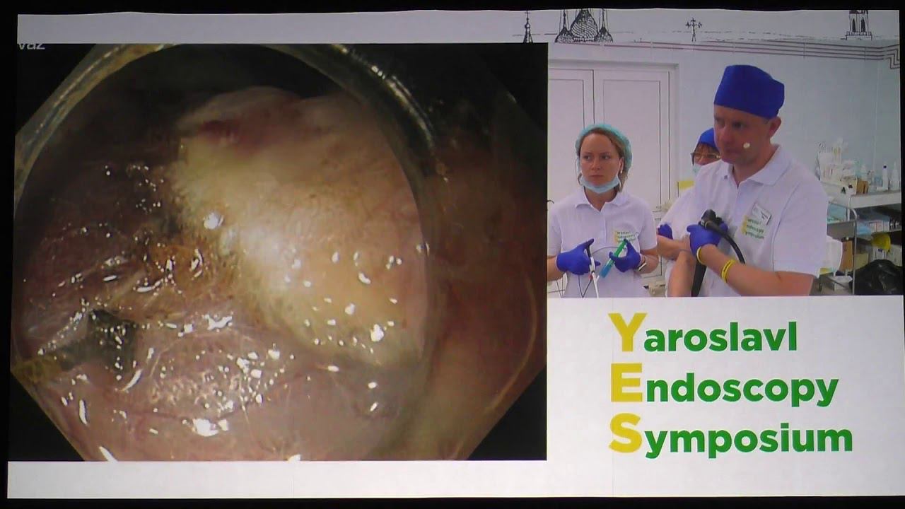 10Live Ткаченко ОБ EFTR GIST желудка полностенная эндоскопическая резекция ГИСО