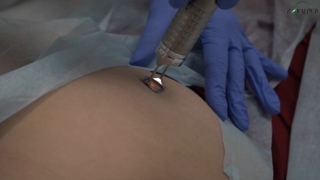 Фракционное лазерное омоложение ягодиц и тела FOTONA смотреть онлайн