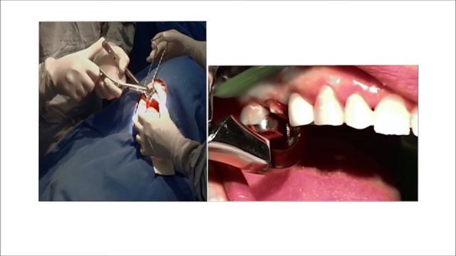 Physics Forceps®  Upper Premolar Extraction