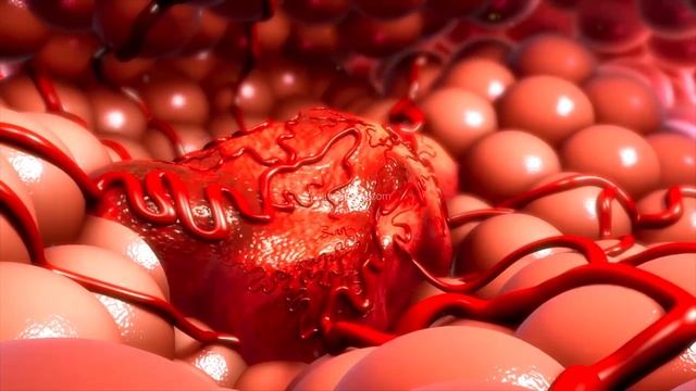 कैंसर (रसायन चिकित्सा) | Cancer (Chemotherapy) | Hindi смотреть онлайн