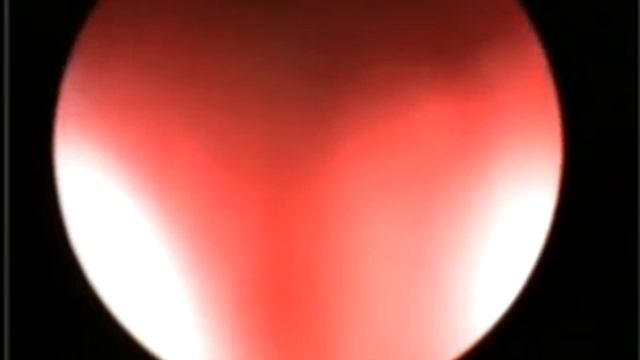 Лапароскопически ассистированная цистоскопия, крупн камни HDTV смотреть онлайн