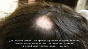 Очаговая алопеция, как быстро лечить?