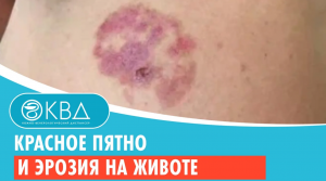 ? Красное пятно и эрозия на животе. Клинический случай №805