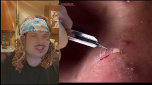 выдавливание прыщей