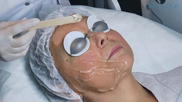 Как проходит процедура фотоомложения на аппарате Lumenis М22?