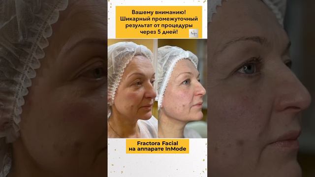 Результат до и после от процедуры Fractora Facial на аппарате Inmode. Доктор: Молочаева Д.Л. смотреть онлайн