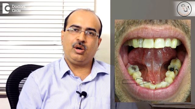 What are the symptoms of a blocked salivary gland? - Dr. Sreenivasa Murthy T M смотреть онлайн