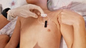 Гемофилия. Установка иглы губера в порт-систему в домашних условиях. Многолетний опыт.