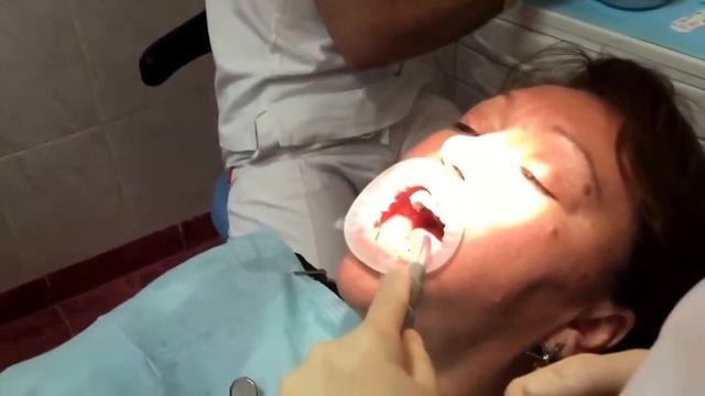 Имплантация зубов смотреть онлайн