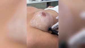 Пример процедуры на груди аппаратом INDIBA