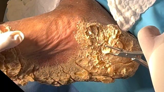 SHAVING CALLUS ON ENTIRE SOLE OF FOOT!!! Dr. Nick Campitelli, Foot & Ankle Surgeon смотреть онлайн