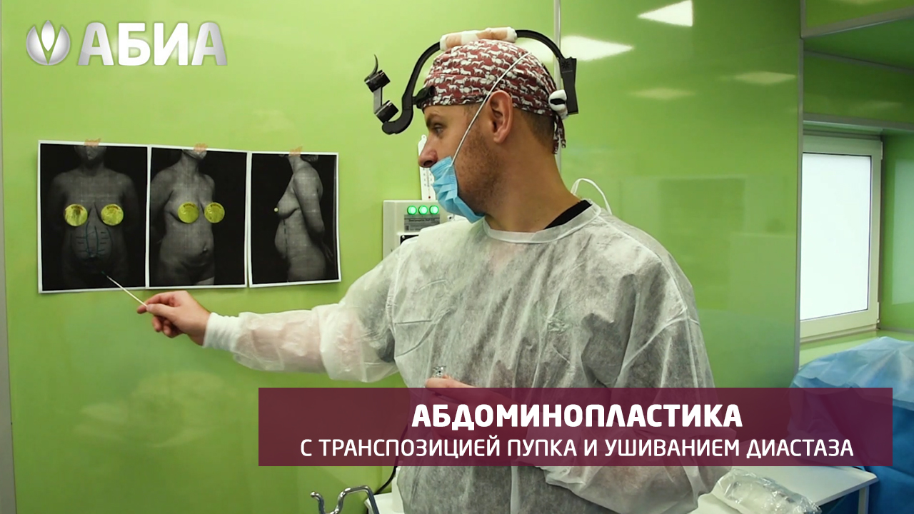 Абдоминопластика с транспозицией пупка и ушиванием диастаза в клинике "АБИА" смотреть онлайн