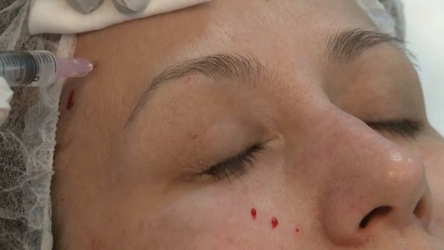 Экспресс лифтинг / EXPRESS LIFTING mesotherapy смотреть онлайн
