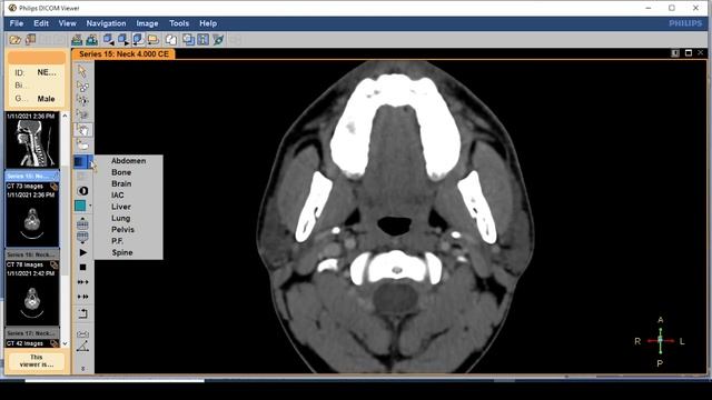 DICOM viewer software... the easiest way to review CTs and MRIs on your PC. смотреть онлайн