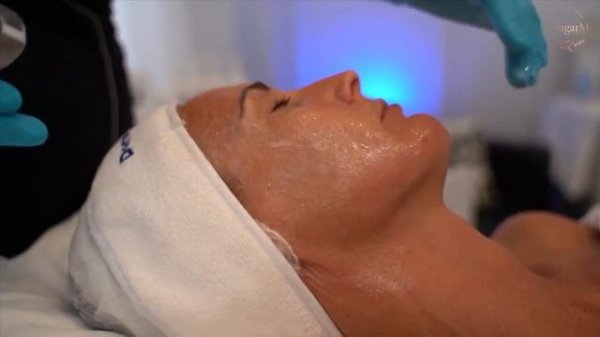 Процедура Дермапен 4 (Dermapen 4), Австралия.