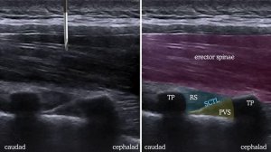Торакальный паравертебральный блок (Ultrasound guided thoracic paravertebral block)