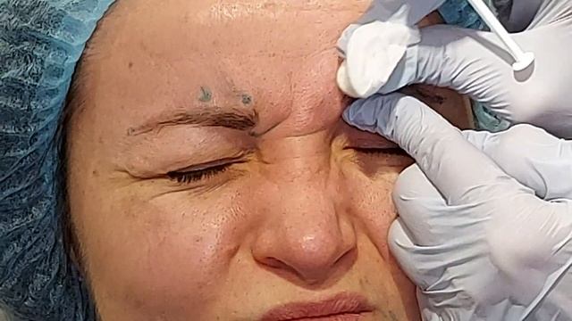 29.01 Токсин межбровка(фрагмент). смотреть онлайн