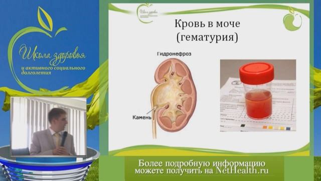 Симптомы мочекаменной болезни - Просянников М.Ю.