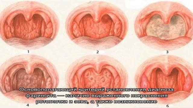 Как выглядит горло ребенка, больного фарингитом? смотреть онлайн