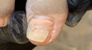 Онихолизис??⚠️❗️??