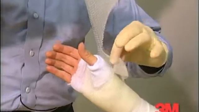 Наложение иммобилизующей повязки 3М Scotchcast® на руку. Повязки 3М Softcast® накладывается так же смотреть онлайн