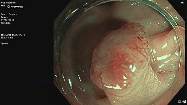 Эпителиальная неоплазия толстой кишки 0-Ip с признаками малигнизации. смотреть онлайн