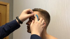 Наложение кинезио тейпов на лицо. Работа с отеками и синяками.