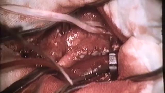 Хирургическое лечение поражений брахиоцефальных сосудов