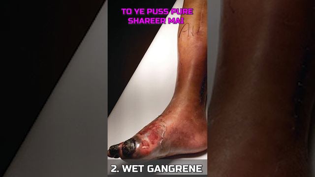 Types of Gangrene | Diabetic Foot | Gangrene | Dr. Gaurav Gangwani смотреть онлайн