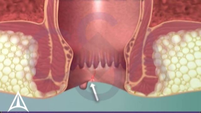 What is an anal fissure? 3D animation смотреть онлайн