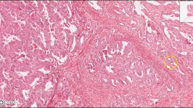 GIT A gastric tumour talking slide - Grading and Staging смотреть онлайн
