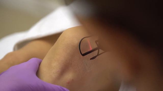 Фракционный лазер. Кисти, локти, колени. смотреть онлайн