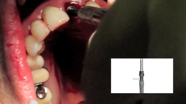 Immediate Dental Implant Surgery - Dr Scott MacLean Front tooth смотреть онлайн