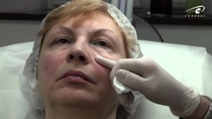 Куда и как колоть канюлей - важные нюансы