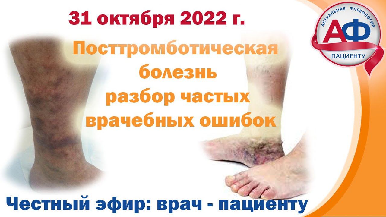 Посттромботическая болезнь = что происходит после тромбоза глубоких вен смотреть онлайн