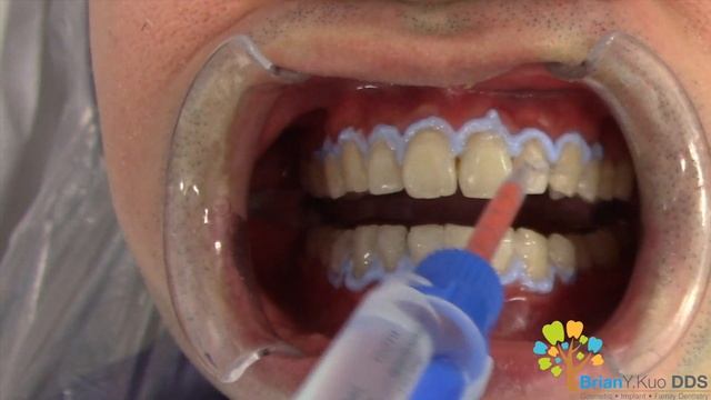 In-Office Teeth Whitening (1 round out of 3) смотреть онлайн