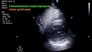 Эхокардиография  - Гипокинезия перегородки левого желудочка
