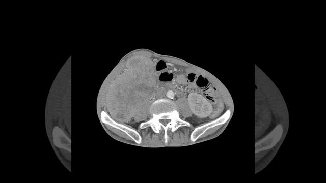 Опухоль печени смотреть онлайн