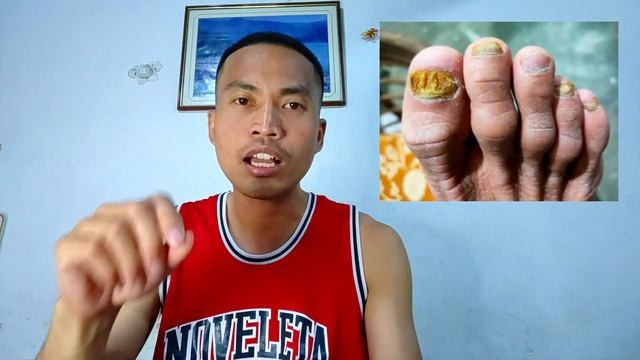 Solusyon sa Nail Fungus | Lanbena Nail Repair Essence Review смотреть онлайн